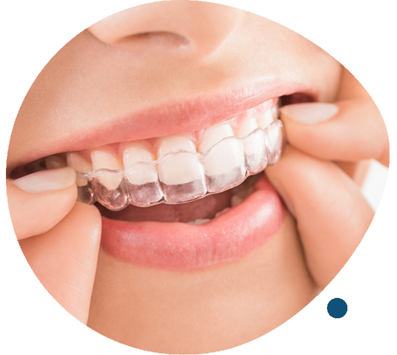 Invisalign Dental Braces Singapore