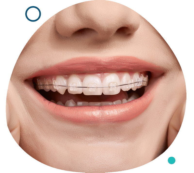 Dental Ceramic Braces Singapore