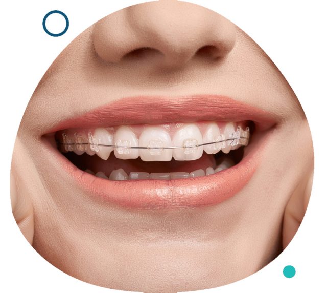 Traditional Ceramic Dental Braces