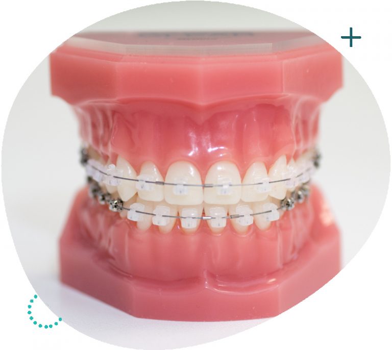 Damon Clear SelfLigating Braces The Braces Practice