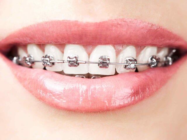 Ceramic Dental Braces