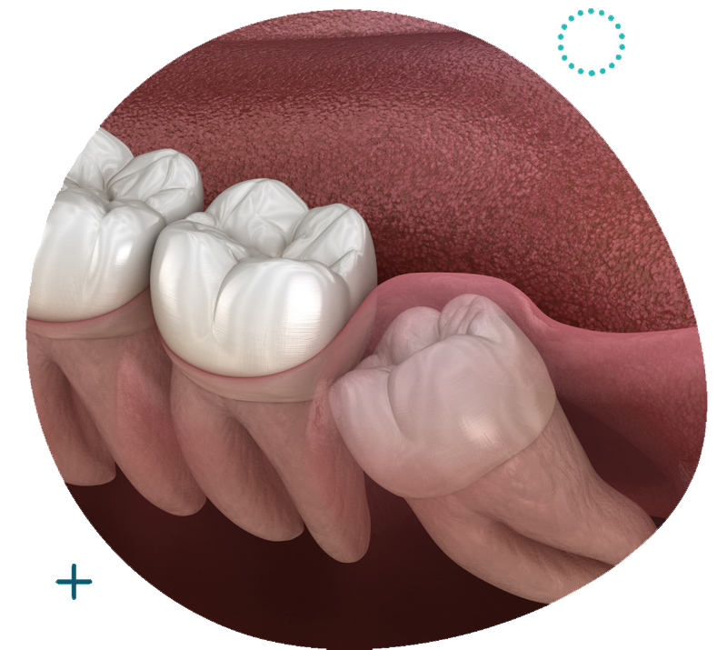 Wisdom Tooth Surgery