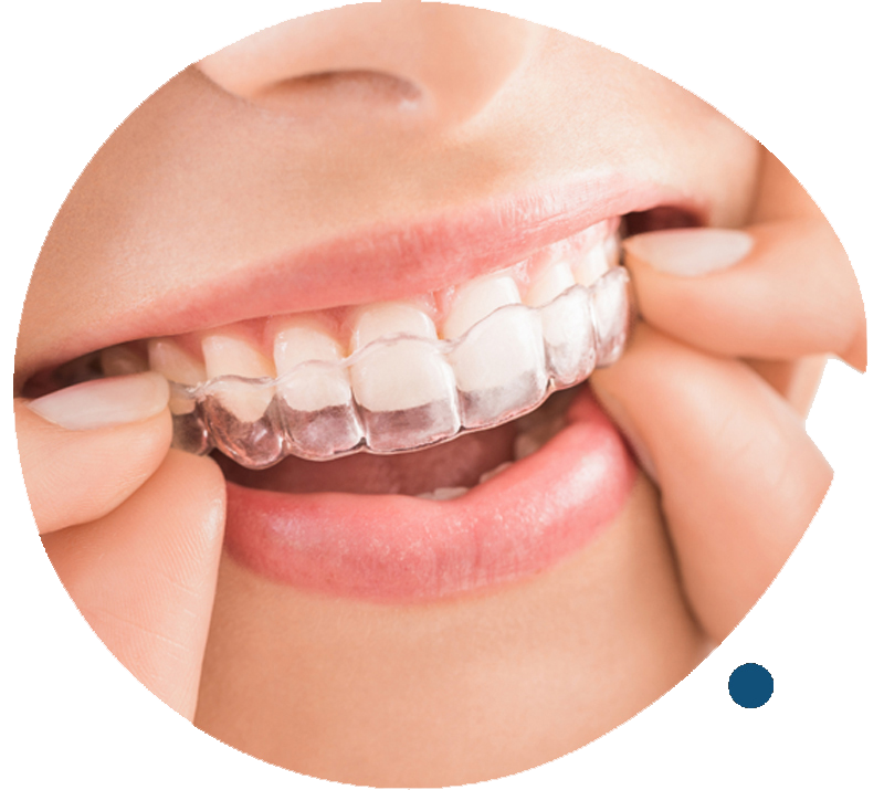 Invisalign Braces