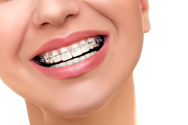 Why Are Damon Clear Braces Becoming A Trend?