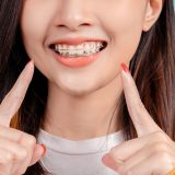 Overcoming Braces Anxiety