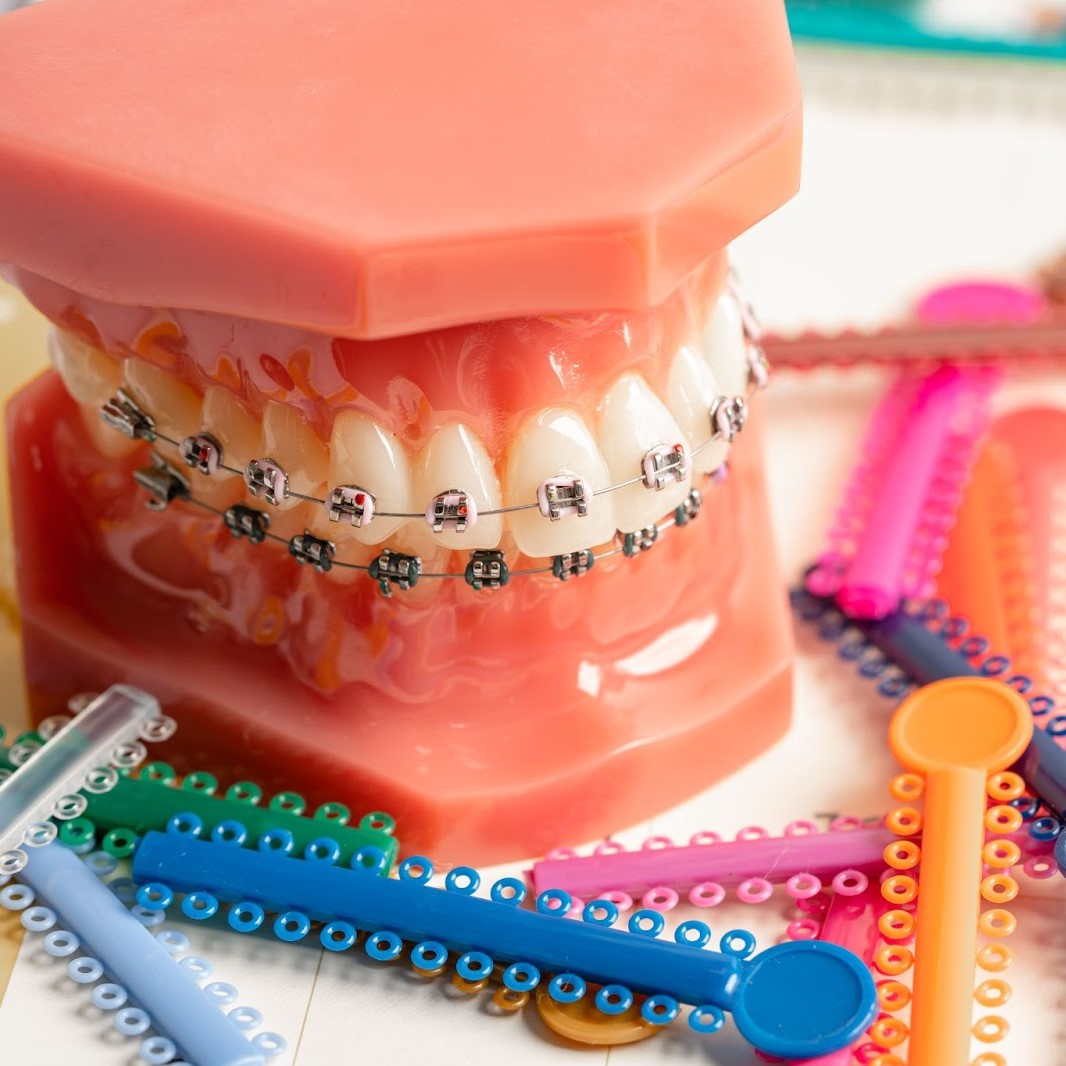 How Do Braces Work? Everything You Need To Know