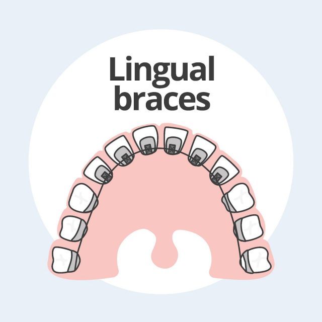 Lingual Braces