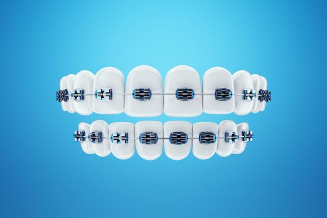 Traditional Metal Braces