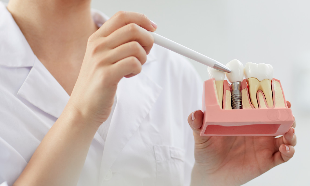 What is Dental Tooth Crown? Everything You Need To Know