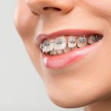Affordable Braces in Singapore A Comprehensive Guide For Cost & Options