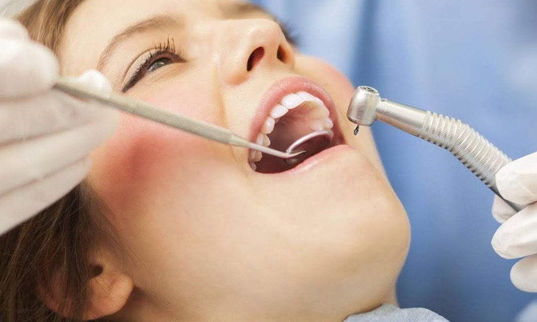 Professional Tips on How to Take Care of Dental Fillings