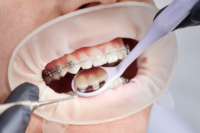 JB Braces Treatment