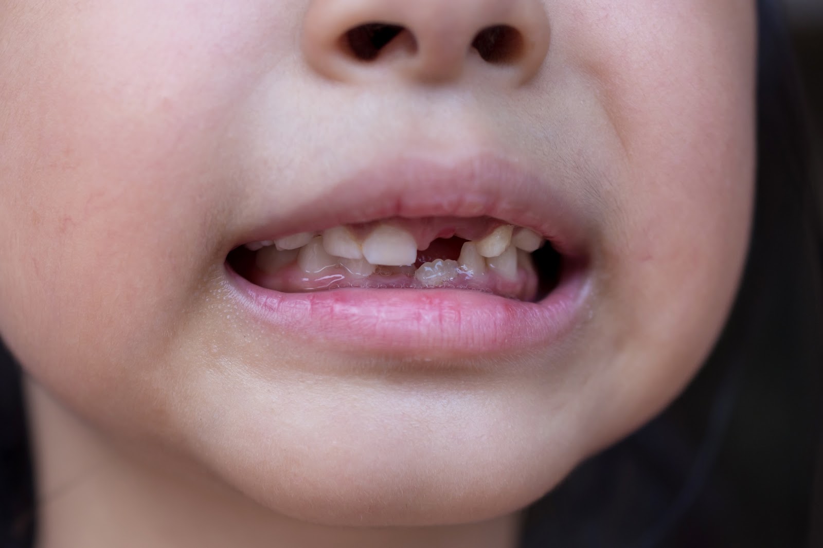 Signs Child Needs Orthodontics