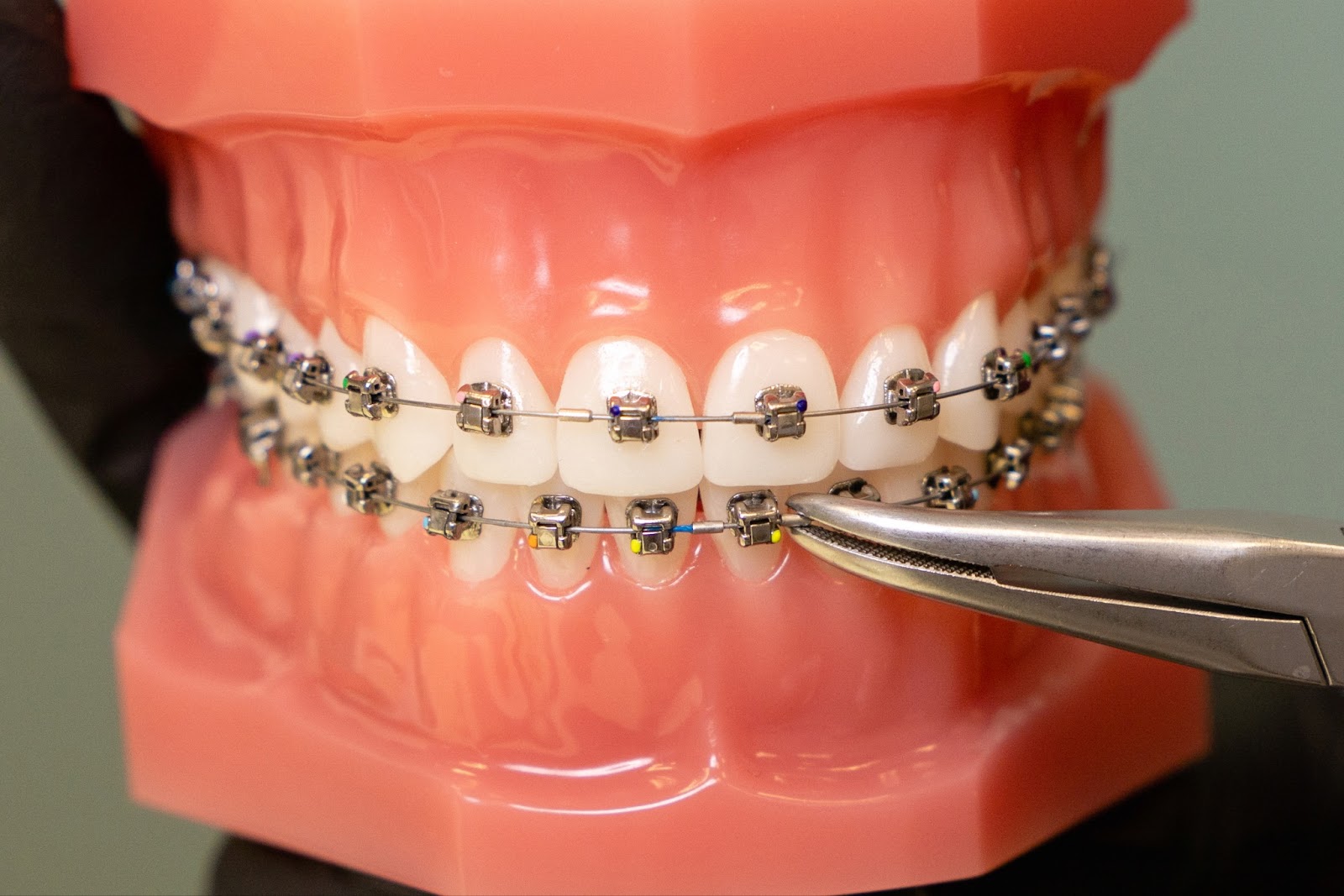 Types of Braces Available