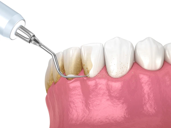 Scaling and Polishing in Singapore – Affordable Dental Clinic in SG