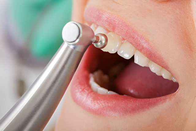 Why Choose Professional Scaling and Polishing