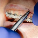Broken Bracket Braces: What You Should Do