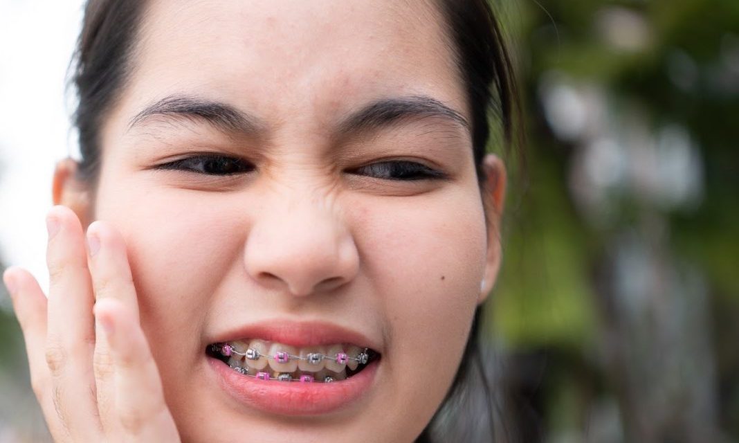 Braces Mouth Sore Relief: Effective Ways to Soothe Discomfort