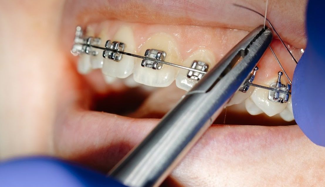 Broken Bracket Braces: What You Should Do