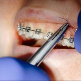 Broken Bracket Braces: What You Should Do