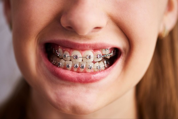 Foods That Can Break Braces: What to Avoid During Treatment