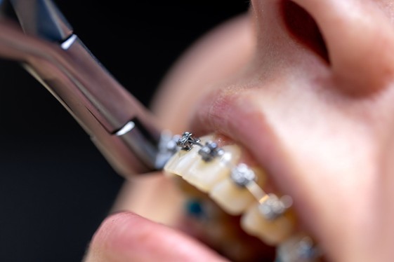 What to Do If Your Braces Break