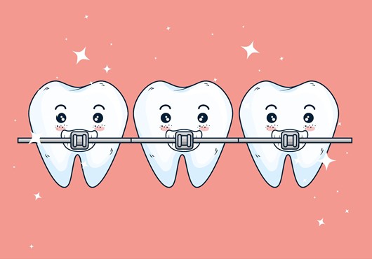 Why Certain Foods Break or Damage Braces
