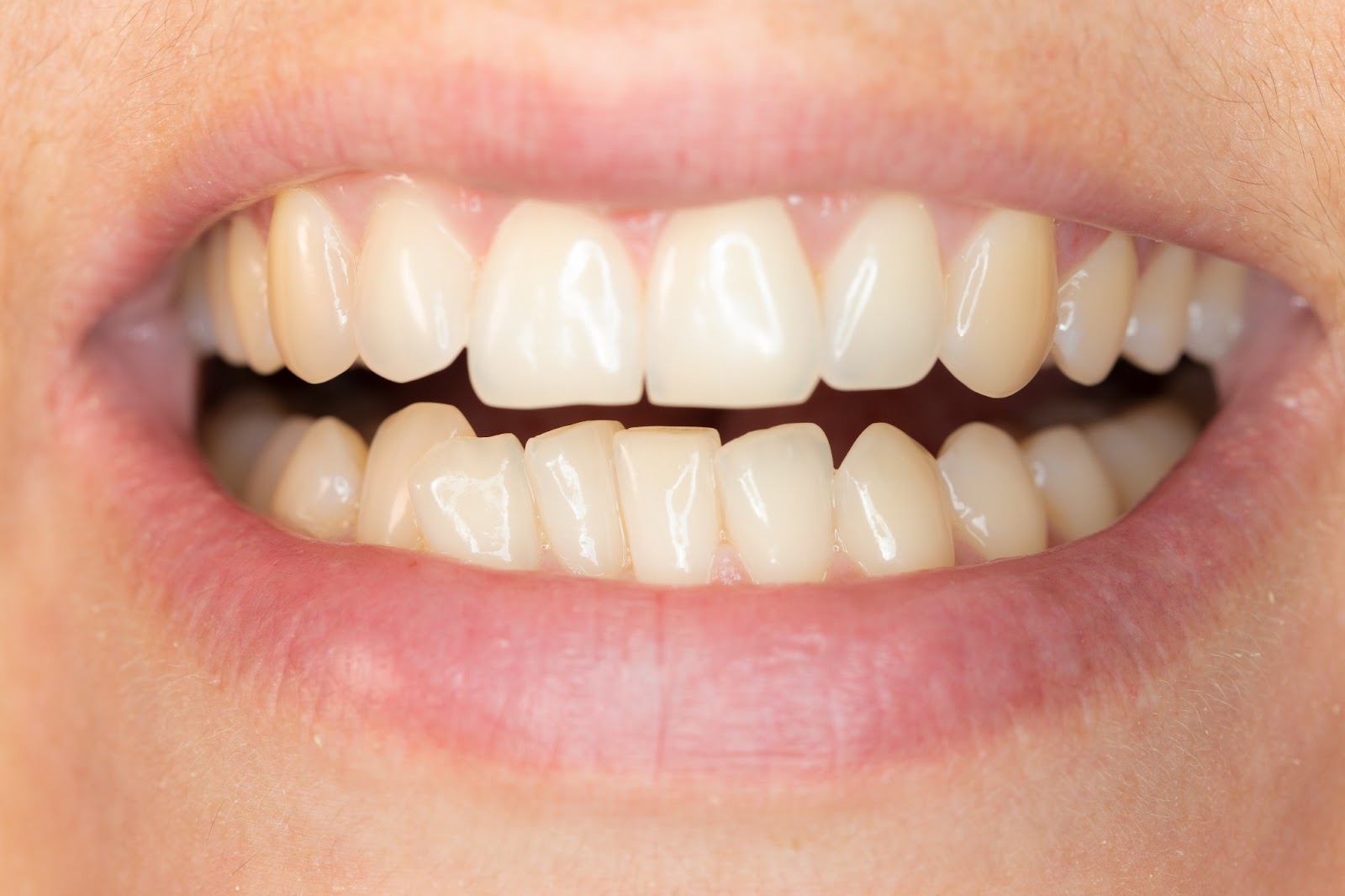 teeth braces practice