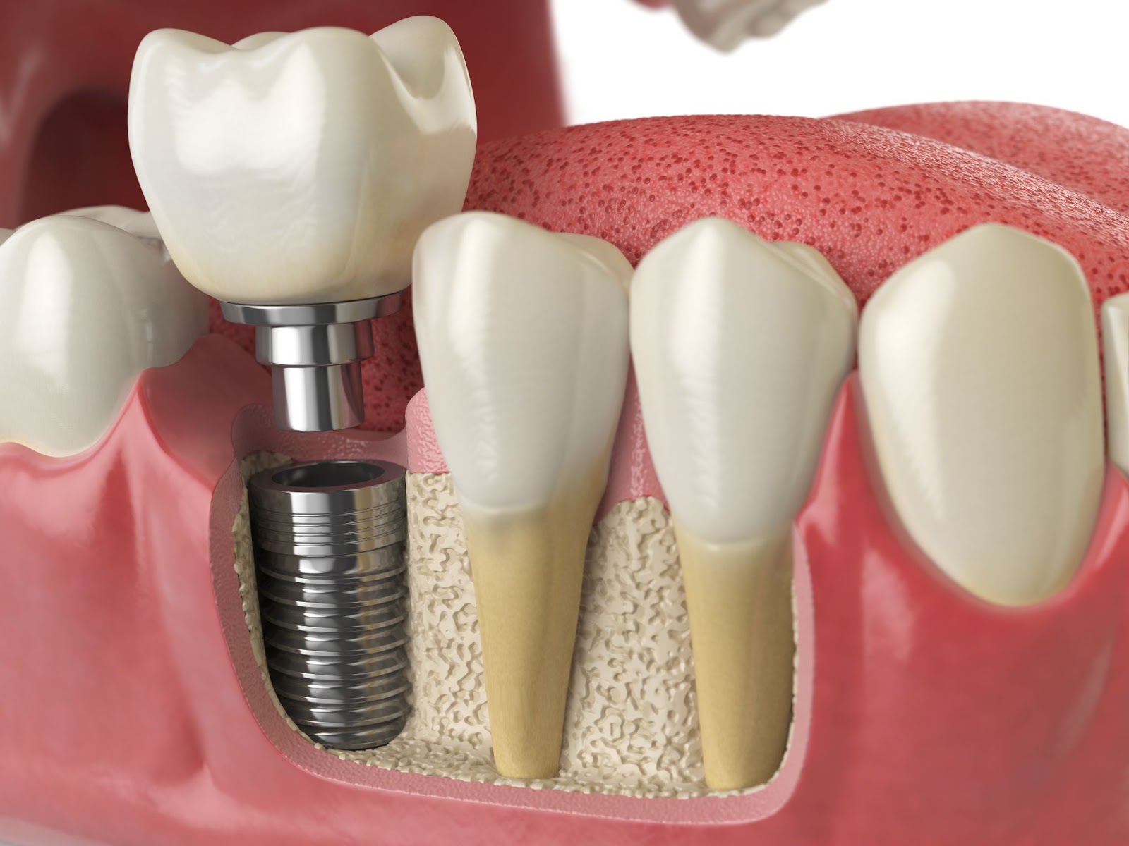 teeth receiving dental implant
