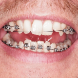 teeth with braces
