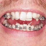 Broken Braces in Singapore