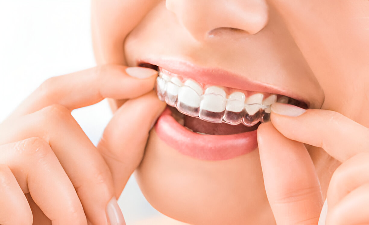 Safer Alternatives for a Beautiful Smile